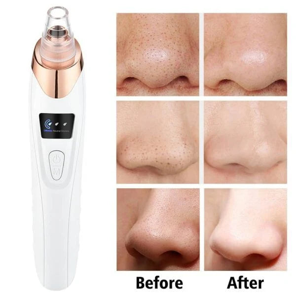 5-in-1 Rechargeable Blackhead Remover & Derma Suction Machine
