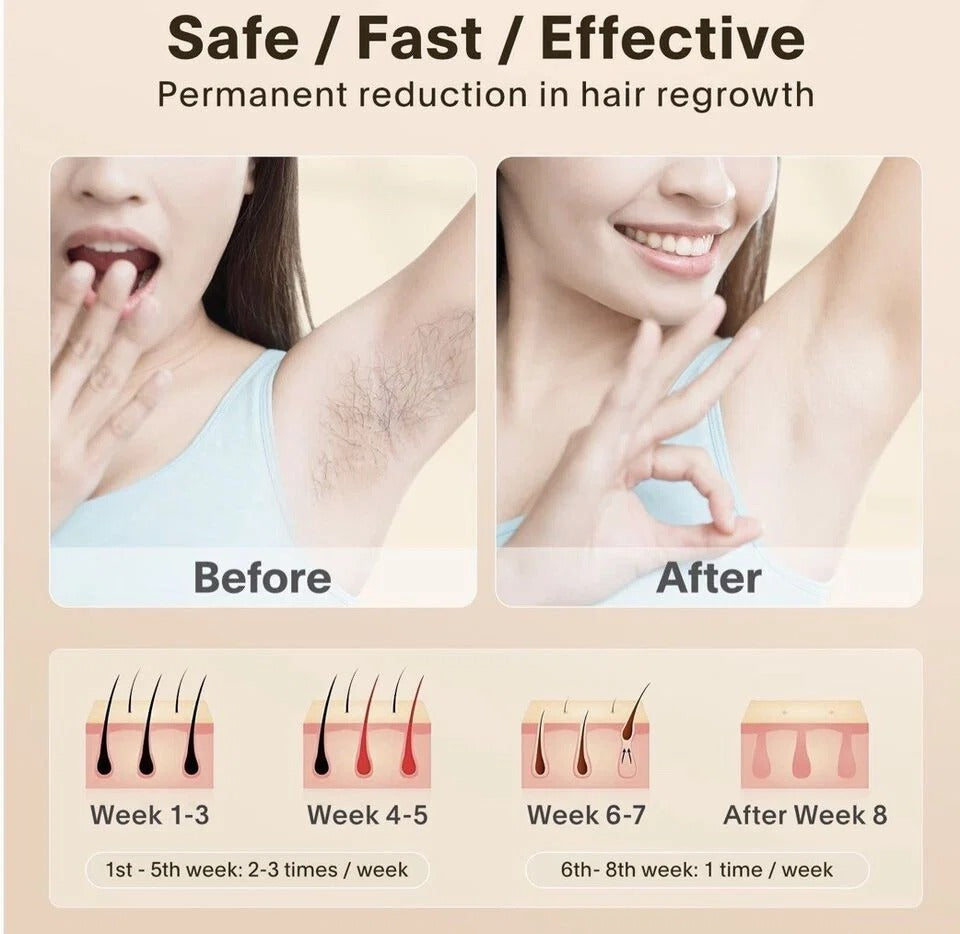 Babyverse SE-2 IPL hair removal  | MYLOR®